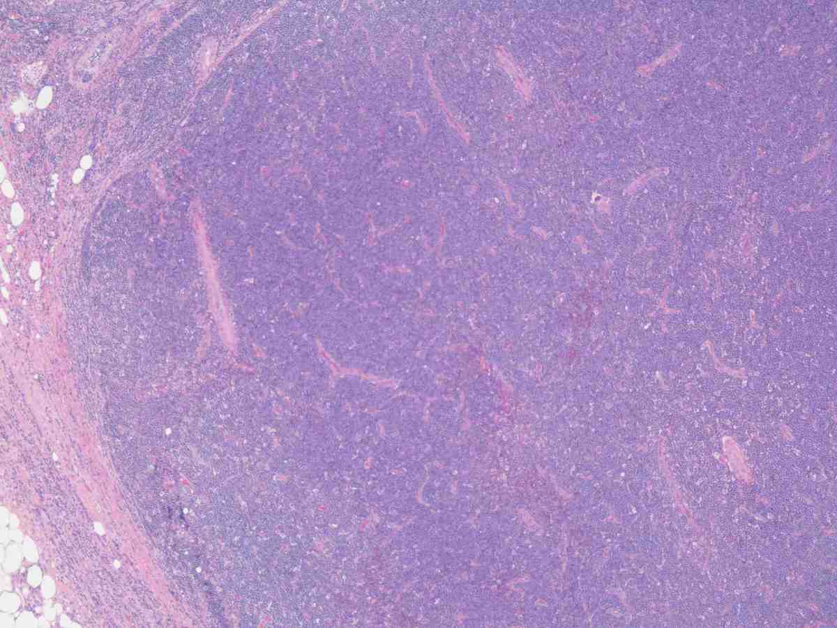 Lymph node 2012 4X HE